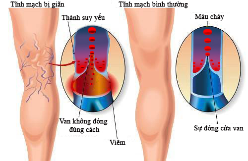 sai lần khi điều trị suy giãn tĩnh mạch - Thiết bị y tế giá gốc