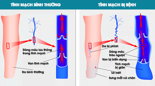 giãn tĩnh mạch là gì - Thiết bị y tế giá gốc