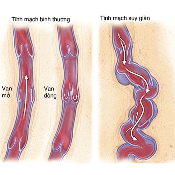 Suy giãn tĩnh mạch là gì?