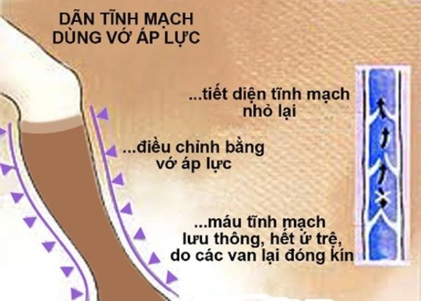 hiệu quả sử dụng vớ - Thiết bị y tế giá gốc