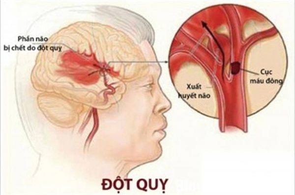 đột quỵ TH