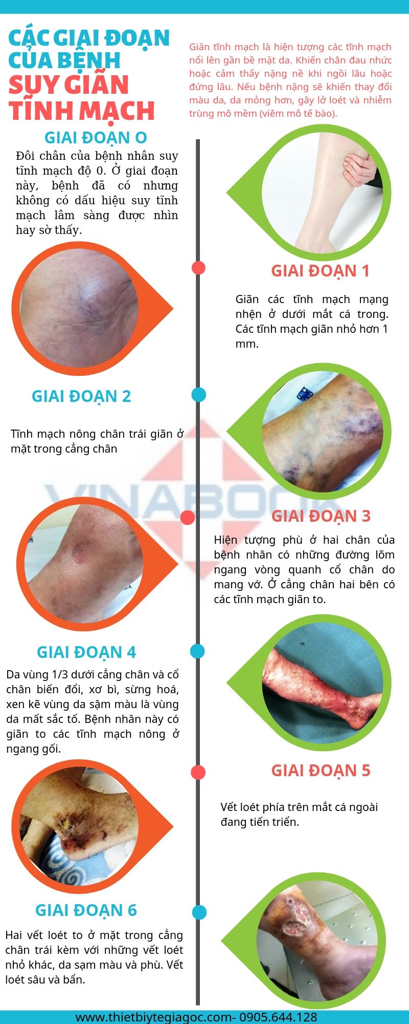 7 cấp độ của suy giãn tĩnh mạch - Thiết bị y tế giá gốc