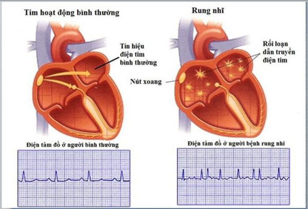 Nguy cơ đột quỵ vì chứng rung nhĩ - Thiết bị y tế giá gốc